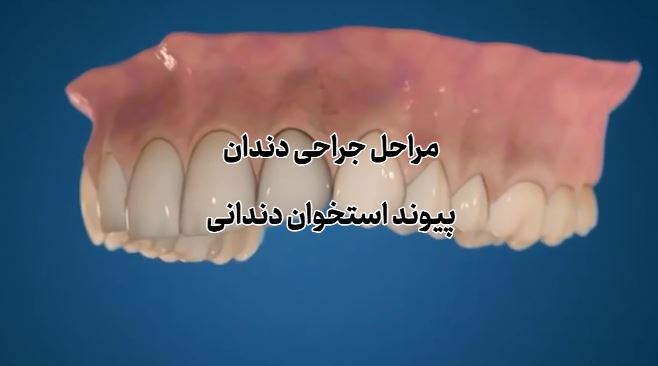 پیوند استخوانی دندان